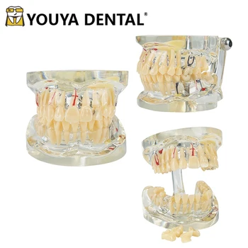 Dantų mokymo modelis Suaugusiųjų patologinis modelis su implantu studentui odontologui, studijuojančiam gydytojo ir paciento bendravimo priemones